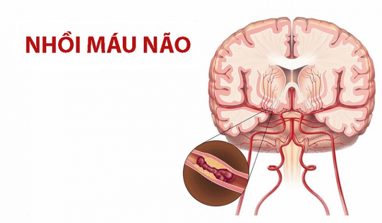 Đột quỵ nhồi máu não – căn bệnh nguy hiểm cần phòng tránh