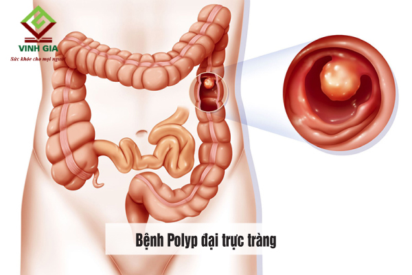 Bệnh Polyp đại trực tràng có triệu chứng đi ngoài ra máu và dịch nhầy
