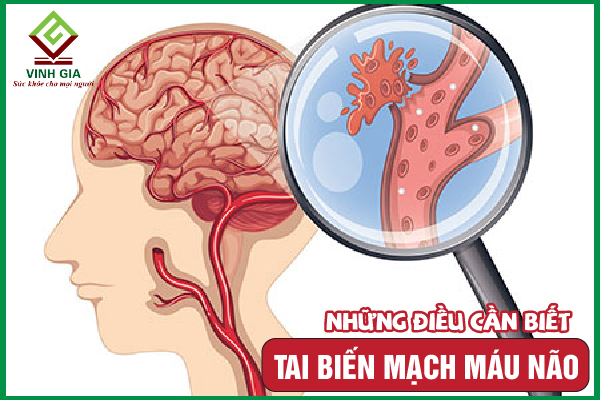 Tai biến mạch máu não là gì? Nguyên nhân và cách xử trí