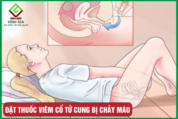 7 nguyên nhân khiến đặt thuốc viêm cổ tử cung bị chảy máu