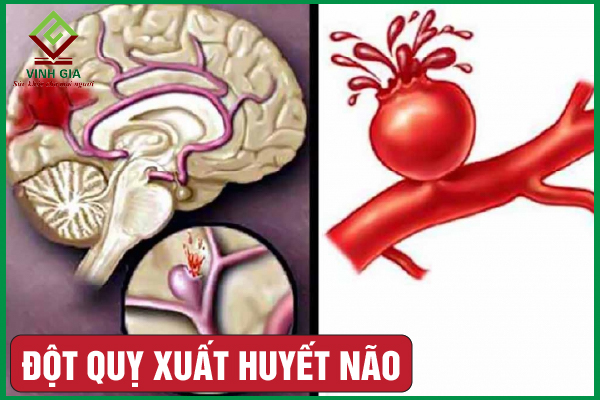 Đột quỵ xuất huyết não: Nguyên nhân, dấu hiệu và xử trí