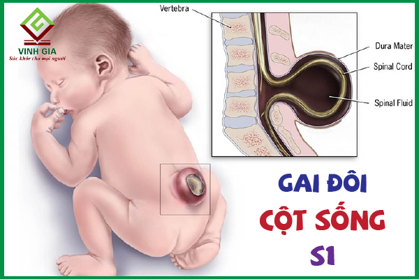 Gai đôi cột sống S1: Nguyên nhân và cách khắc phục tốt