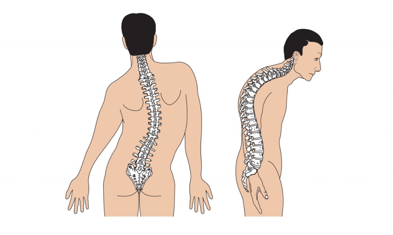 Nên khám vẹo cột sống ở đâu uy tín tốt nhất?