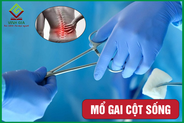 Mổ gai cột sống có nguy hiểm không? Nên lưu ý gì?