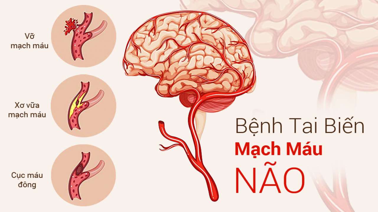 Tai biến mạch máu não là gì? Nguyên nhân và cách điều trị tốt nhất