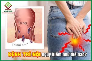 Bệnh trĩ nội: Nguyên nhân, triệu chứng và cách chữa trị hiệu quả