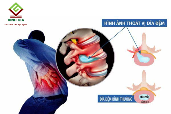 Bị thoát vị đĩa đệm có thể gây đau lưng phía bên phải Bị thoát vị đĩa đệm có thể gây đau lưng phía bên phải