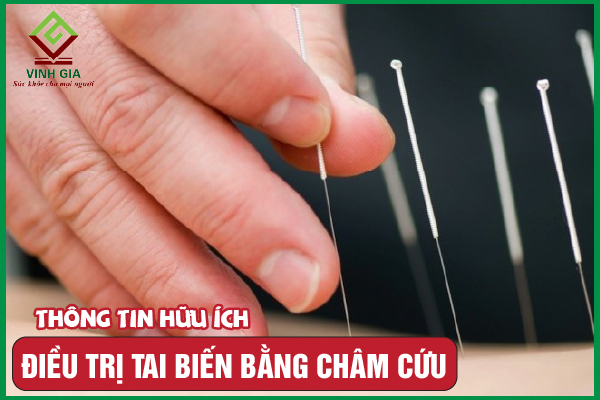 Người bệnh tai biến có nên châm cứu hay không?
