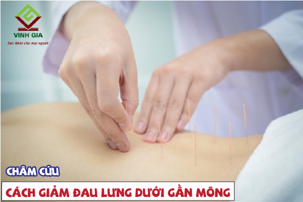 Châm cứu là phương pháp cực kỳ tốt để giảm đau lưng gần mông hiệu quả Châm cứu là phương pháp cực kỳ tốt để giảm đau lưng gần mông hiệu quả