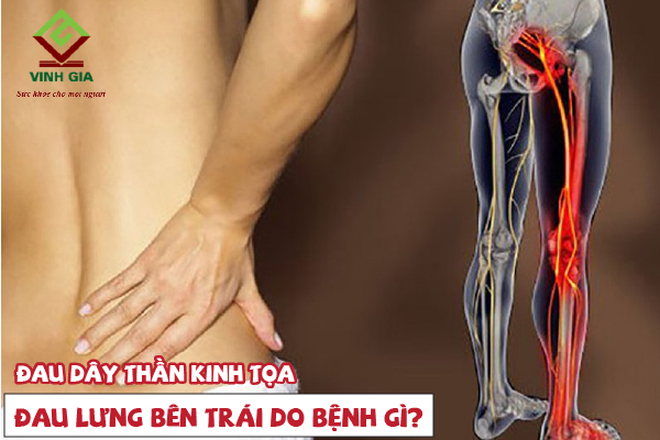 Đau lưng bên trái là do đau dây thần kinh tọa Đau lưng bên trái là do đau dây thần kinh tọa