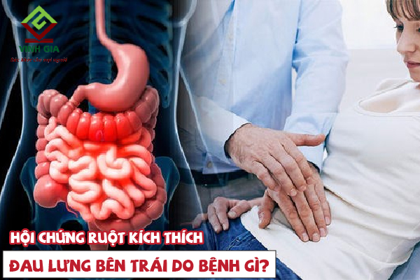 Đau lưng bên trái là do hội chứng ruột kích thích Đau lưng bên trái là do hội chứng ruột kích thích
