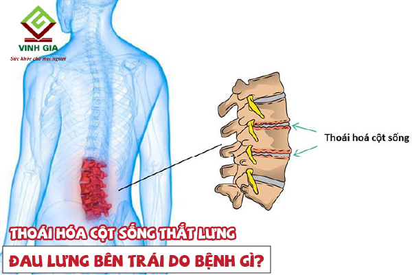 Đau lưng bên trái là do thoái hóa vùng cột sống thắt lưng Đau lưng bên trái là do thoái hóa vùng cột sống thắt lưng