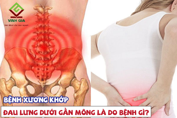 Đau lưng dưới gần mông là dấu hiệu của bệnh xương khớp Đau lưng dưới gần mông là dấu hiệu của bệnh xương khớp