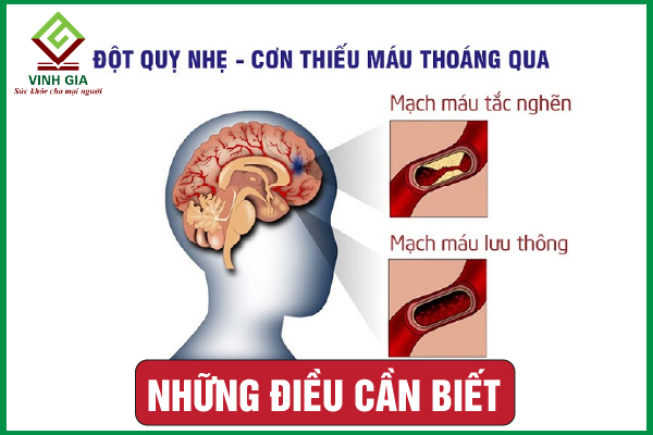 Những dấu hiệu đột quỵ nhẹ và cách xử lý đúng