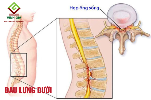 Hẹp ống sống gây áp lực lên các rễ dây thần kinh làm đau nhức lưng dưới