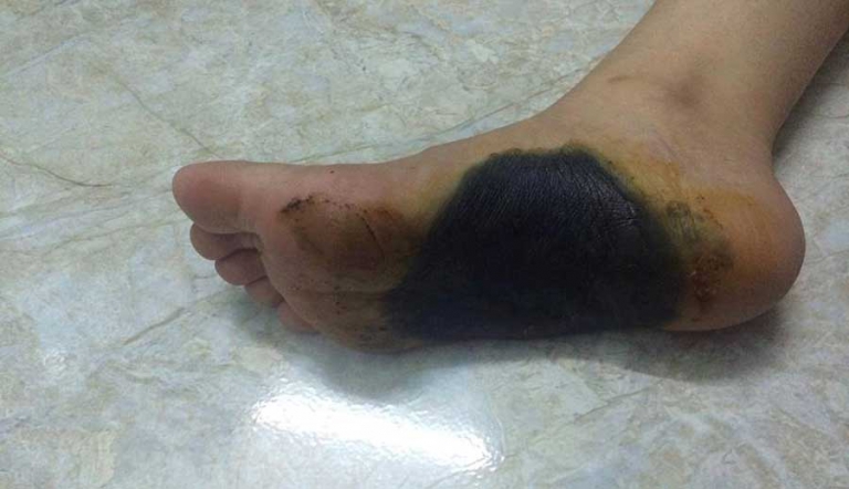 Có nên dùng thuốc bó chân chống đột quỵ không?