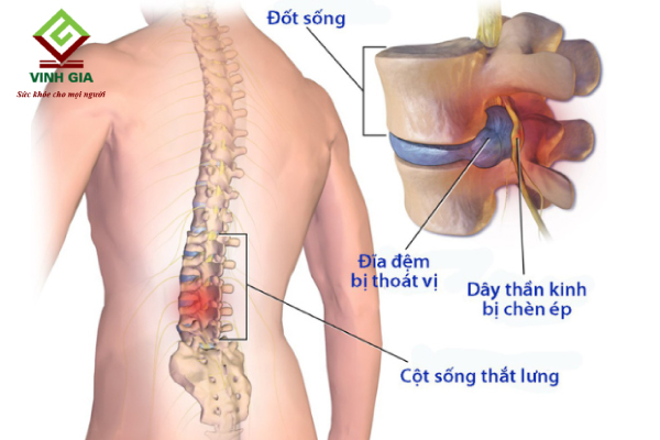 Viêm thân sống đĩa đệm là nguyên nhân thường gặp gây đau lưng dưới