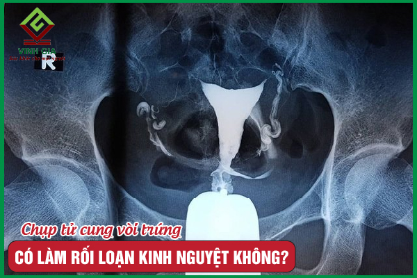 Chụp tử cung vòi trứng có làm rối loạn kinh nguyệt không?