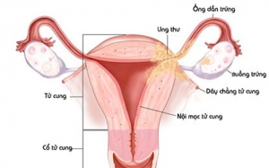 Làm gì khi bị rối loạn kinh nguyệt sau chụp tử cung vòi trứng Làm gì khi bị rối loạn kinh nguyệt sau chụp tử cung vòi trứng