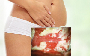 Gợi ý các loại thuốc và lưu ý khi sử dụng thuốc trị nấm âm đạo Gợi ý các loại thuốc và lưu ý khi sử dụng thuốc trị nấm âm đạo