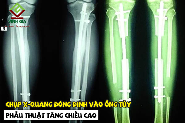 Hình ảnh chụp X-quang phẫu thuật kéo dài chân