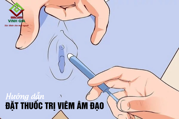 Hướng dẫn sử dụng thuốc đặt viêm âm đạo hiệu quả nhất Hướng dẫn sử dụng thuốc đặt viêm âm đạo hiệu quả nhất