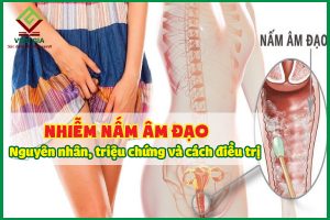 Nhiễm nấm âm đạo: Nguyên nhân, triệu chứng và cách điều trị