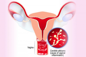 Nguyên nhân khiến nấm Candida sinh sôi và phát triển Nguyên nhân khiến nấm Candida sinh sôi và phát triển