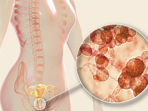 Cách điều trị viêm âm đạo do nấm Candida Cách điều trị viêm âm đạo do nấm Candida