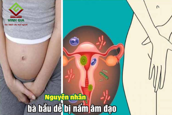 Những nguyên nhân dẫn đến bà bầu bị nấm âm đạo khi mang thai