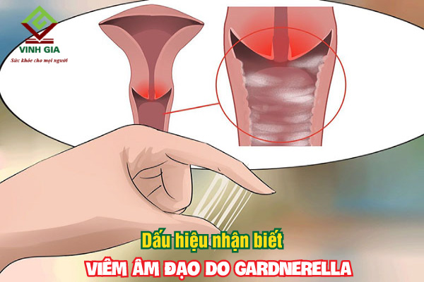 Những triệu chứng nhận biết bệnh viêm âm đạo do Gardnerella vaginalis