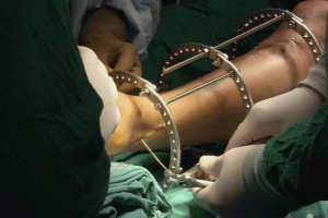Hiểu rõ về phương pháp phẫu thuật kéo dài chân