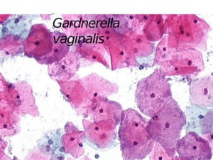 Viêm âm đạo do gardnerella vaginalis phức tạp thế nào?