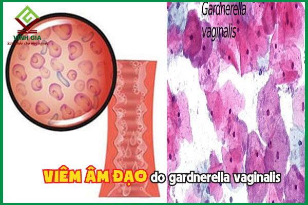 Viêm âm đạo do gardnerella vaginalis phức tạp thế nào?