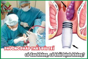 Phương pháp thắt búi trĩ có đau không, có khỏi bệnh không?