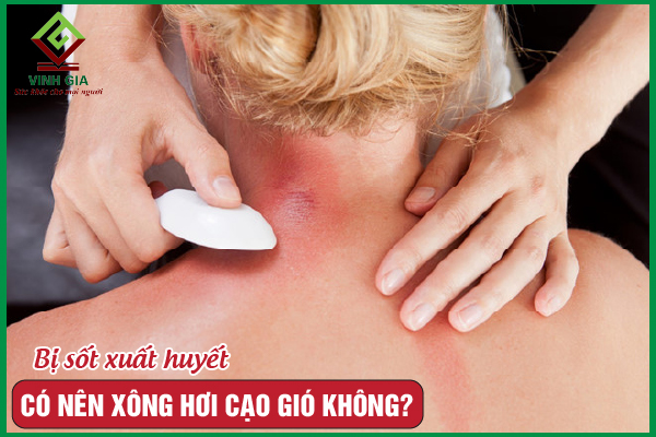 Sốt xuất huyết có nên xông hơi cạo gió không?