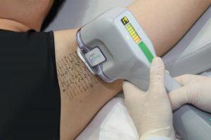 Trị hôi nách bằng công nghệ miraDry có an toàn không? Trị hôi nách bằng công nghệ miraDry có an toàn không?