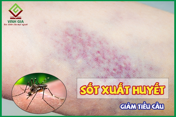 Sốt xuất huyết giảm tiểu cầu: Nguyên nhân và cách khắc phục
