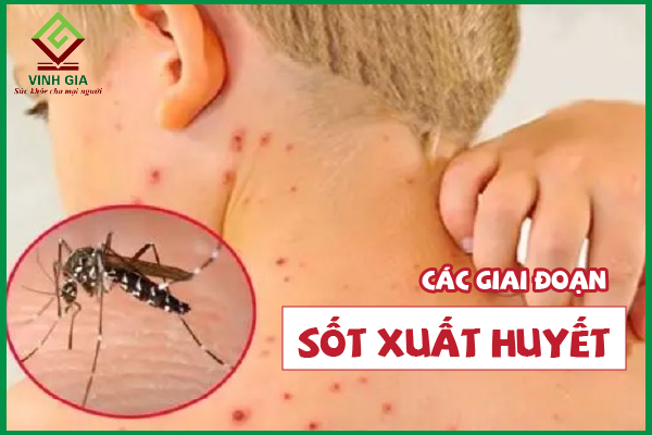 3 giai đoạn phát triển của bệnh sốt xuất huyết