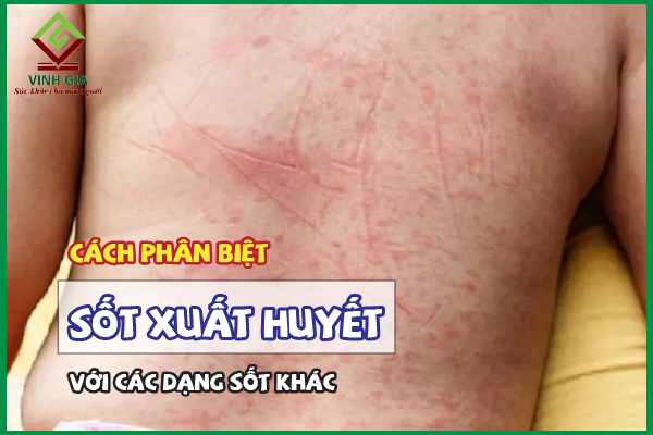 Phân biệt sốt xuất huyết với các dạng sốt khác