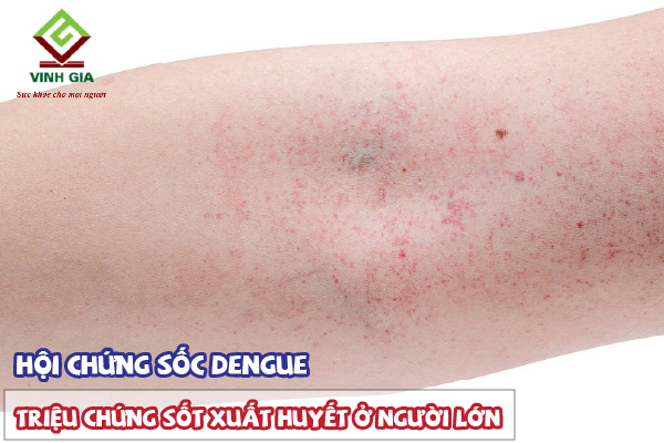 Hội chứng sốc Dengue ở người lớn