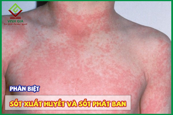 Phân biệt sốt xuất huyết và sốt phát ban khác nhau như nào?