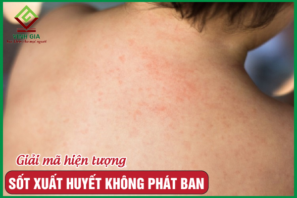 Giải đáp vì sao sốt xuất huyết không phát ban?