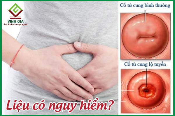 Viêm lộ tuyến cổ tử cung có nguy hiểm không?