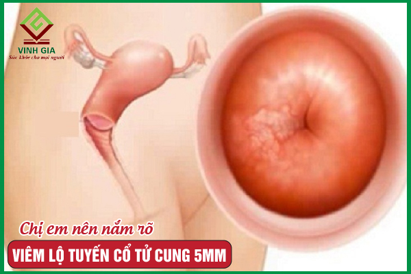 Mách chị em cách phòng và điều trị viêm lộ tuyến 5mm