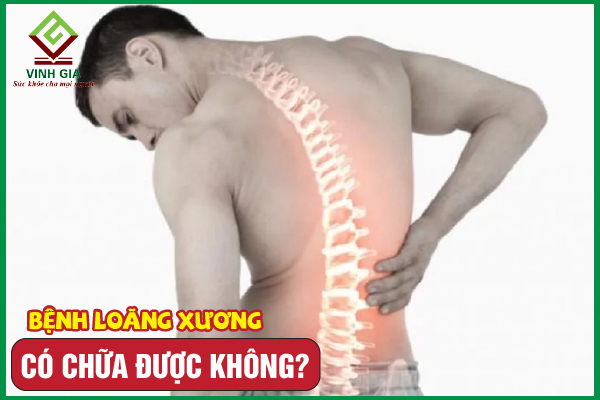 Bệnh loãng xương có chữa được không? Điều trị như thế nào?