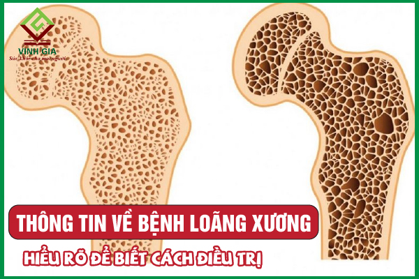 Bệnh loãng xương: Nguyên nhân, dấu hiệu, chẩn đoán và điều trị