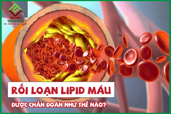 Tiêu chuẩn chẩn đoán rối loạn lipid máu như thế nào?