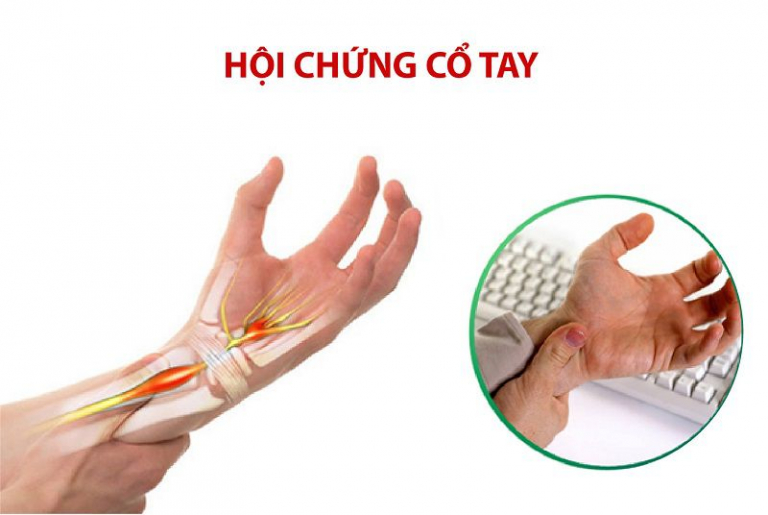 Hội chứng ống cổ tay: Nguyên nhân, dấu hiệu và ngăn ngừa