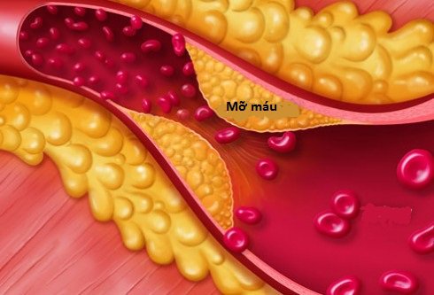 Mỡ máu cao là gì? Ai là người có thể bị mỡ máu cao?